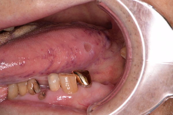舌の口内炎 Ti歯科医院 日本橋の歯医者
