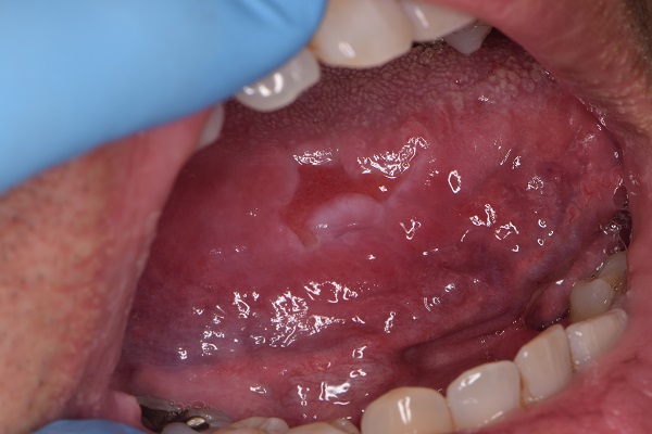 裏 舌 口内炎 原因 の 唇に口内炎が出来る原因は？３つの治し方を知っておこう！