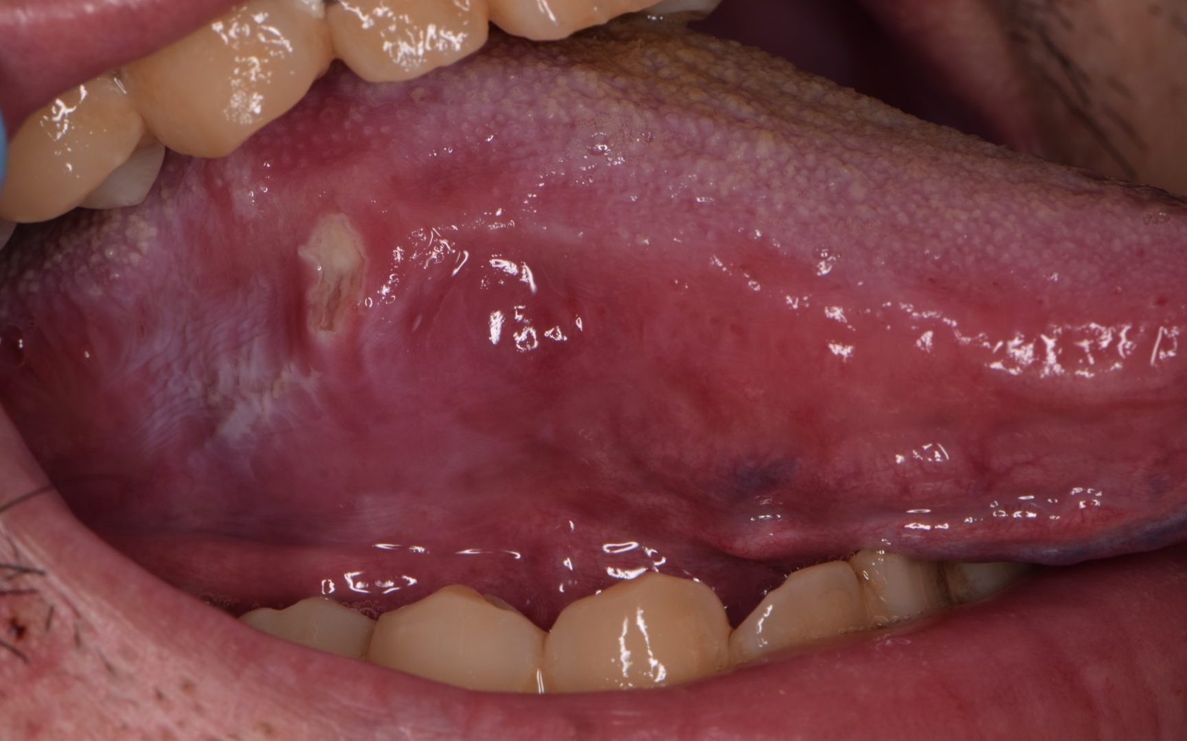 歯 が 舌 に当たる 対処