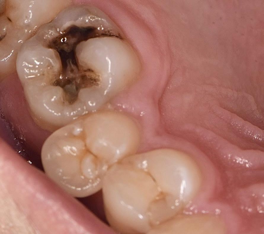 歯 の 詰め物 取れ た 放置